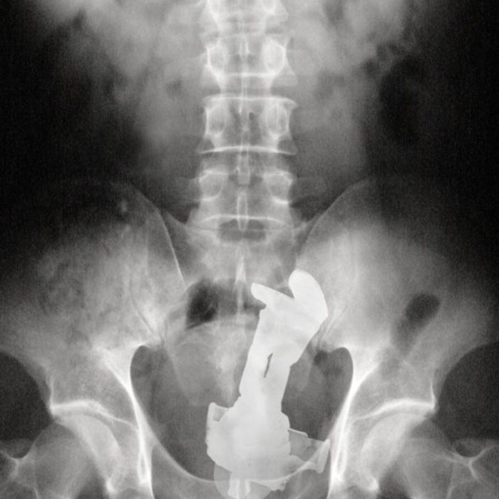 10 More X Rays Of Strange Things Stuck Up The Butt Lovense Blog