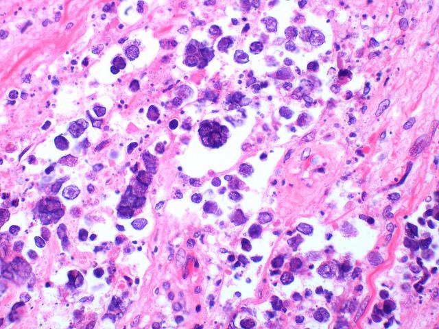 What Is Herpes Simple Guide To Cold And Genital Sores