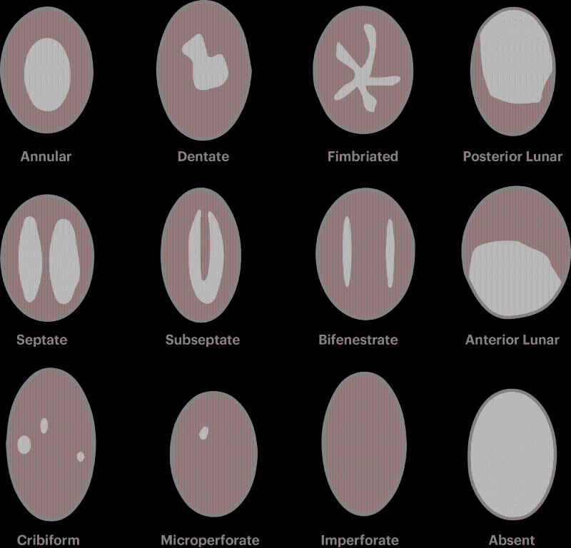 The Different Types of Hymen – You’re Not Popping Anything